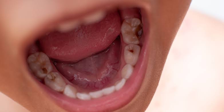 Dientes con caries