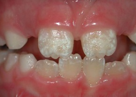 Dientes con manchas blancas