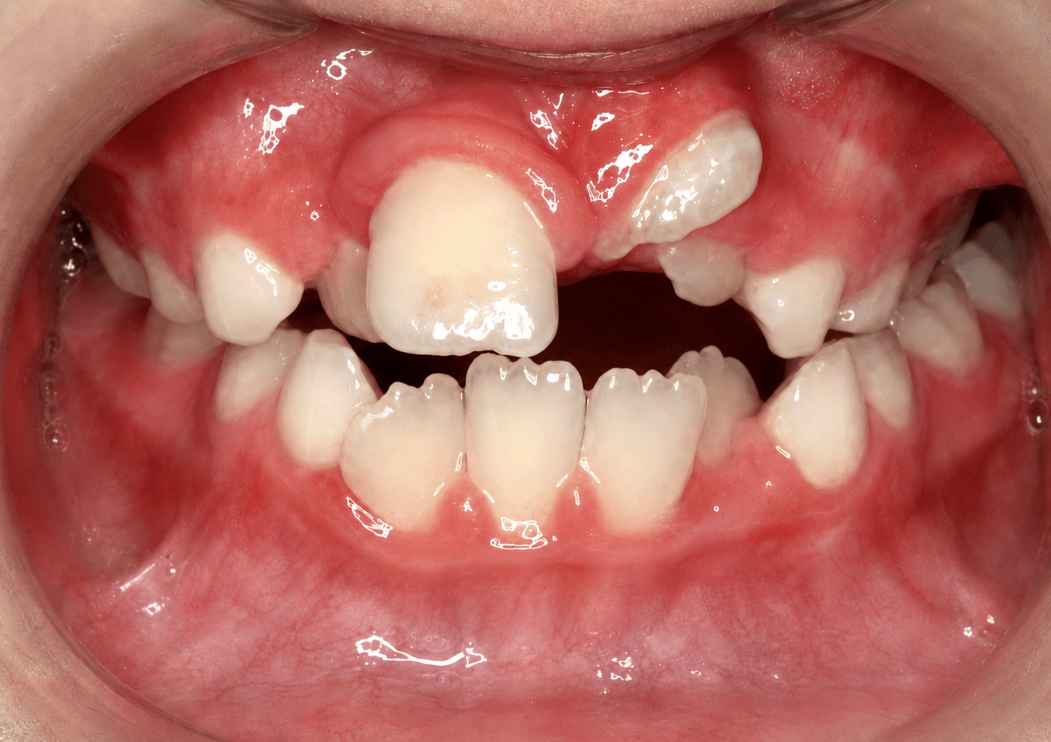 Dientes torcidos